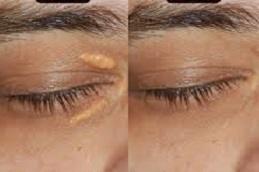 Eyelid Xanthelasma Removal in Dubai.