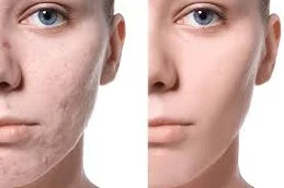 Hypertrophic Scars Treatment before & After Dubai