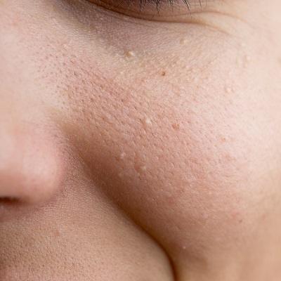 Milia Treatment in Dubai & Abu Dhabi