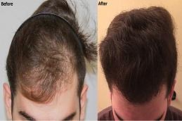 PRF Hair Treatment before & After.