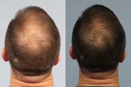 PRF Hair Treatment before & After clinic Dubai