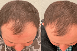 PRF Hair Treatment before & After clinic Dubai