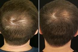 PRF Hair Treatment before & After
