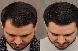 PRF Hair Treatment before clinic Dubai