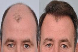PRF Hair Treatment before clinic in Dubai
