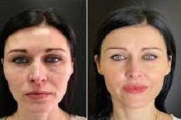 PRP Treatment For Face Cost in Dubai.