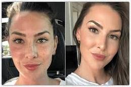 PRP Treatment For Face Cost in Dubai