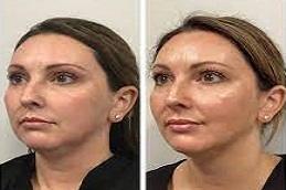 PRP Treatment For Face clinic in Dubai