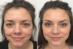 PRP Treatment For Face in Dubai