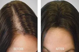 Results Will PRGF Look Natural clinic Dubai