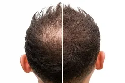 Results Will PRGF Look Natural clinic in Dubai