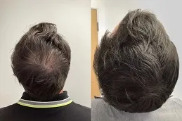 Results Will PRGF Look Natural
