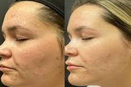 Results of Biorepeel Treatment Dubai.