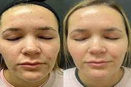 Results of Biorepeel Treatment Dubai