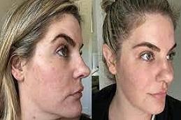 Results of Biorepeel Treatment in Dubai