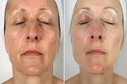 Salmon DNA Sperm Facial Dubai