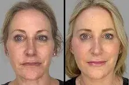 Salmon DNA Sperm Facial before & After 