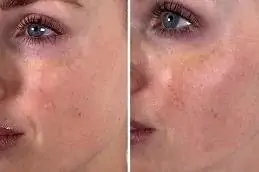 Salmon DNA Sperm Facial before & After