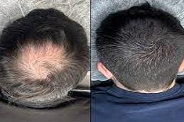 Scalp Micro Pigmentation (SMP) Dubai