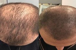 Scalp Micro Pigmentation (SMP) Dubai