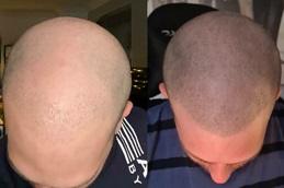 Scalp Micro Pigmentation (SMP) before & after Dubai.