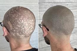 Scalp Micro Pigmentation (SMP) before & after Dubai,