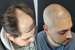 Scalp Micro Pigmentation (SMP) before & after Dubai