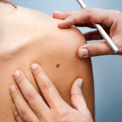 Sebaceous Cyst Removal Cost in Dubai & Abu Dhabi
