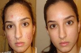 Acne Scar Treatment clinic in Dubai