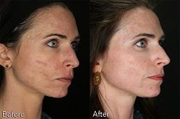 Acne Scar Treatment in before After