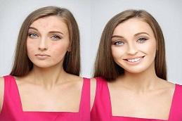 Acne Scars Before & After in Dubai