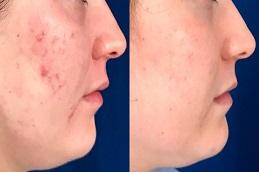Acne Treatment before & after Dubai & Abu Dhabi