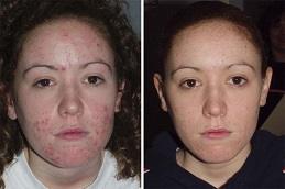 Acne Treatment before & after clinic Dubai & Abu Dhabi