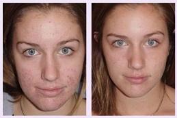Acne Treatment before & after clinic Dubai