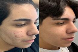 Acne Treatment before & after in Dubai & Abu Dhabi