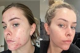 Acne Treatment before & after in Dubai