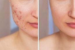 Acne Treatment before & after