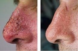 Actinic Keratosis Treatment before & After Clinic Dubai