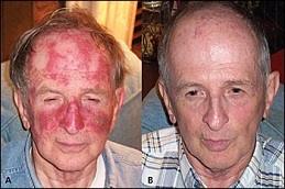 Actinic Keratosis Treatment before & After Clinic in Dubai