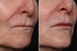 Actinic Keratosis Treatment before & After in Dubai