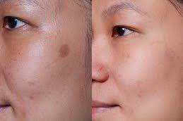 Actinic Keratosis Treatment before & After