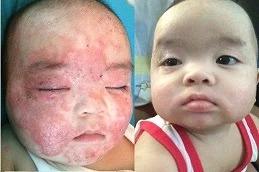 Baby Skin Facial before & After Dubai