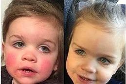 Baby Skin Facial before & After in Dubai