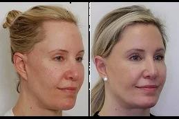 Best American Hair Transplant Clinic Dubai