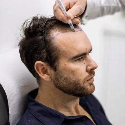 Best American Hair Transplant Clinic Dubai