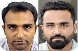 Best American Hair Transplant Clinic before & After.