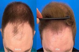Best American Hair Transplant Clinic before & After Dubai