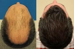 Best American Hair Transplant Clinic before & After