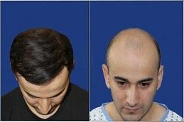 Best American Hair Transplant Clinic in Dubai