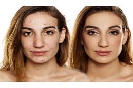 Best Dermal Fillers for Deep Acne Scars in Dubai & Abu Dhabi